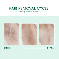 Laser Hair Removal